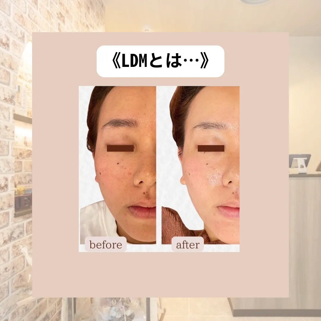 【柏市】美容皮膚科でも人気!話題のLDMとは…?乾燥肌.鎮静💆♀️